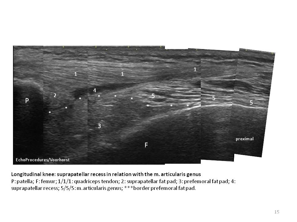 m-articularis-genus-ultrasound-image-echoprocedures