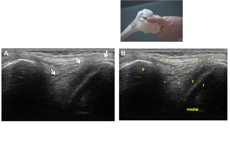 how to find a medial plica in your knee? – Echoprocedures